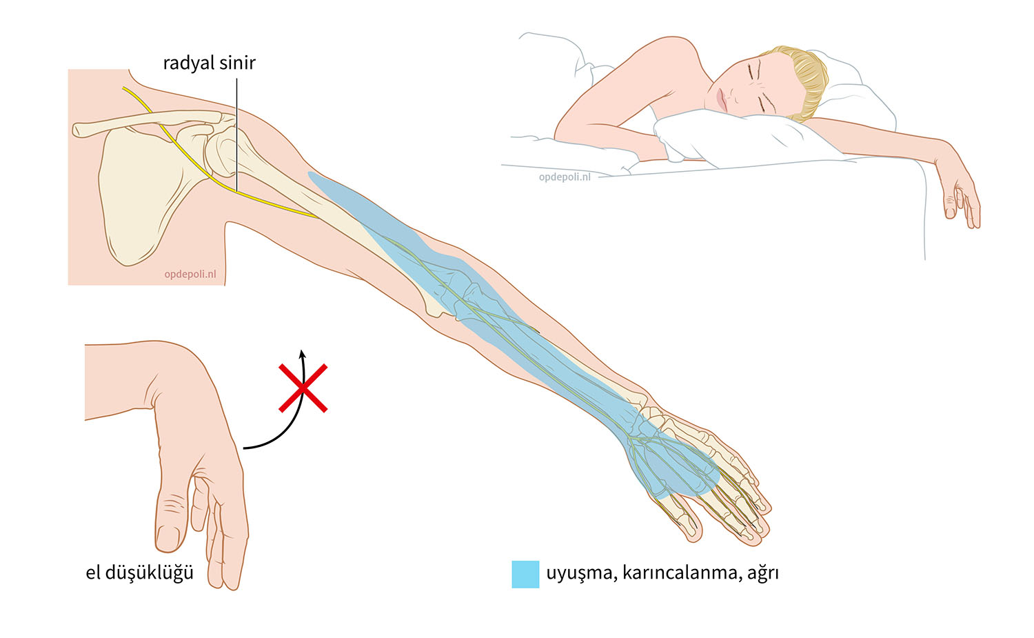 radialis_neuropathie