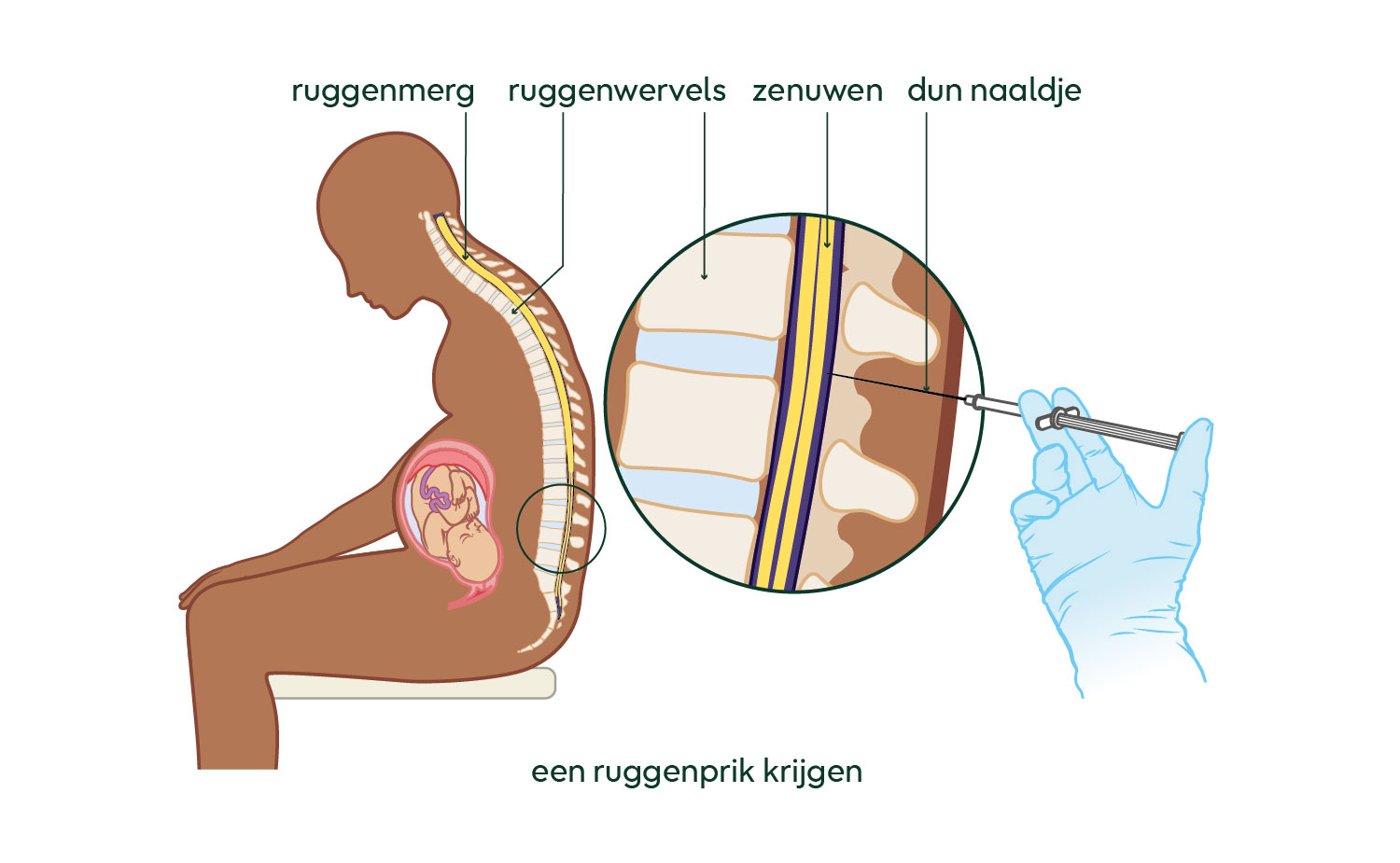 ruggenprik
